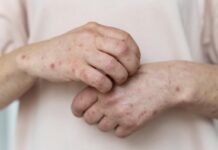 Корь, паротит, краснуха: что нужно знать