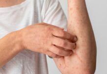 ВОЗ объявила эпидемию оспы обезьян в Африке чрезвычайной ситуацией