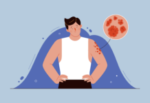 Врач рассказала, как достичь ремиссии при псориазе