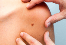 Почему важно прививаться от вируса папилломы человека