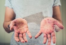 Корь напоминает о себе…