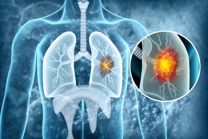 Lung-Cancer-Tumor-Disease